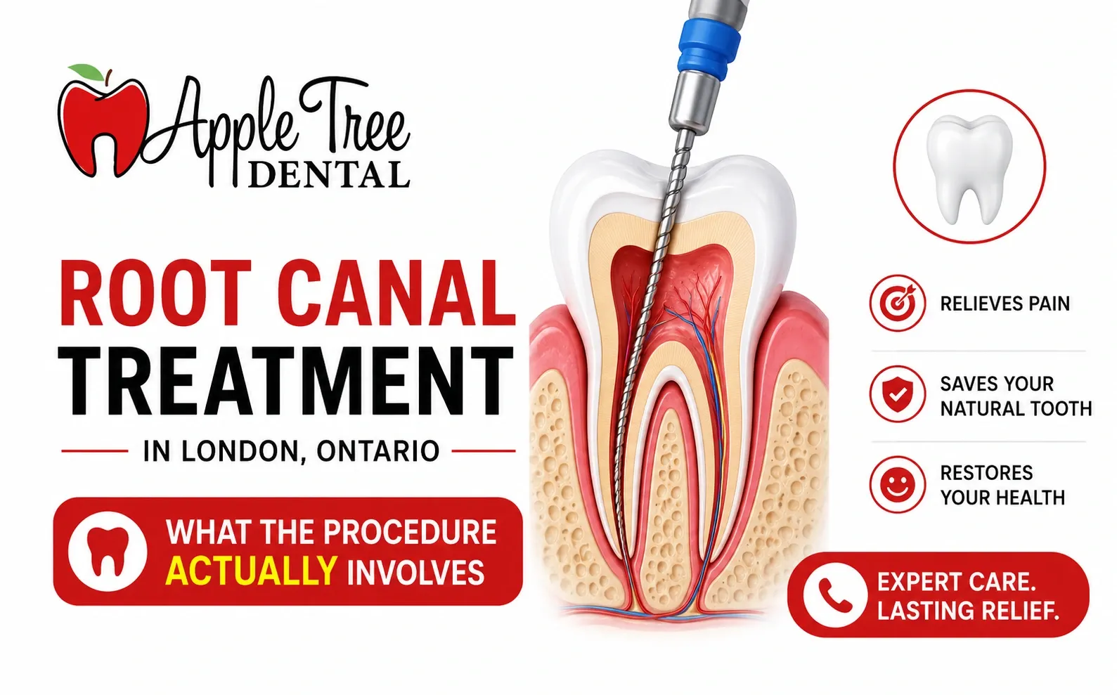 Root Canal Treatment in London, Ontario: What the Procedure Actually Involves