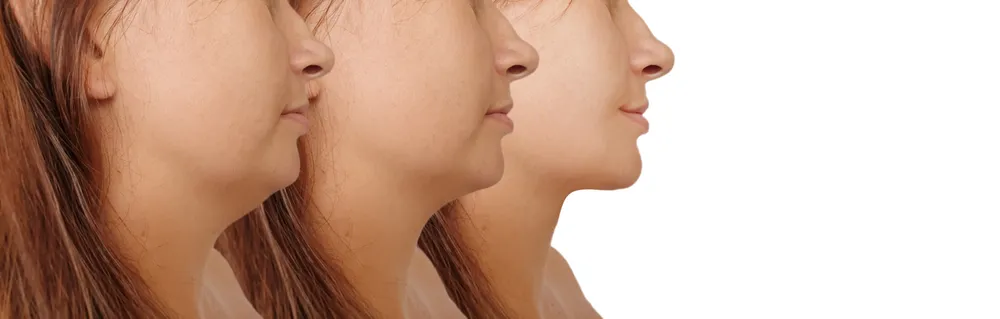 Why More Patients Choose Juvederm for Safe and Natural Facial Enhancement