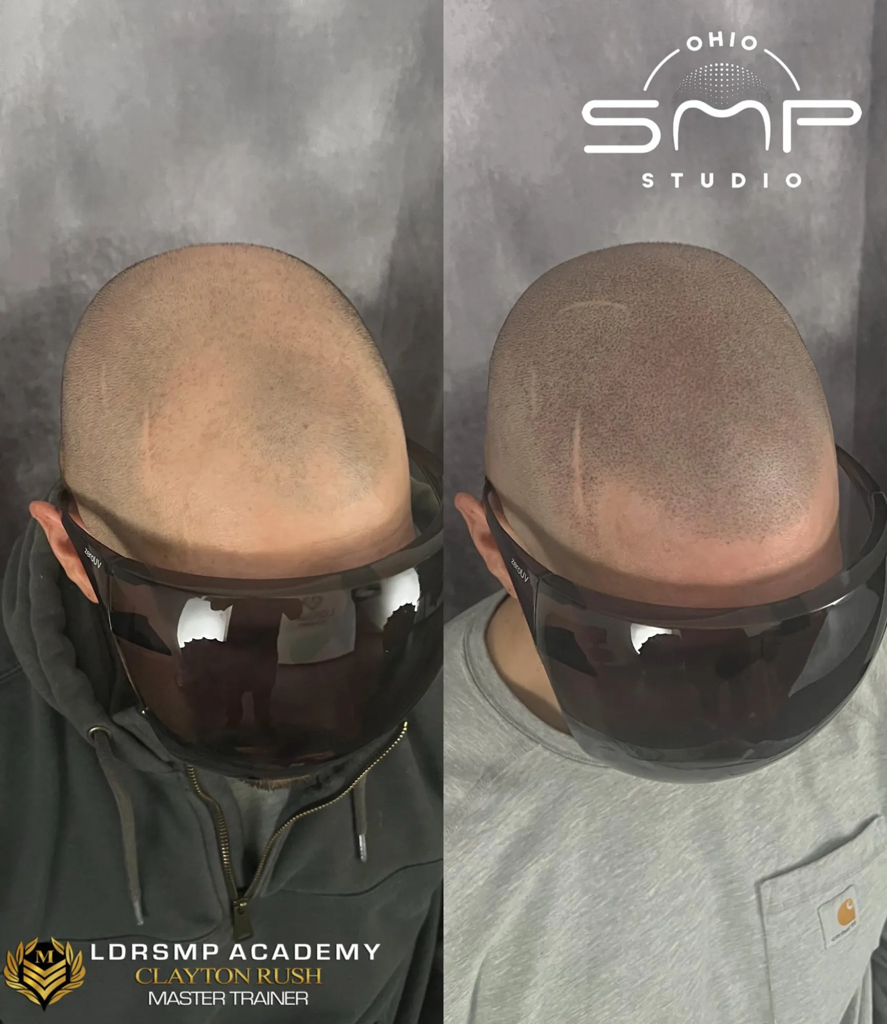 Scalp Micropigmentation: The Trusted Hair Loss Solution in Dublin
