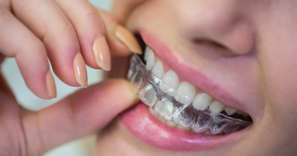 Invisalign Specialist Kings Park: What to Expect During Your Smile Journey