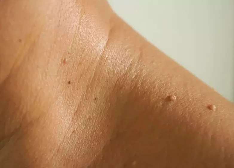 Skin Tag Removal Cape Town: A Simple Way to Get Clearer Skin