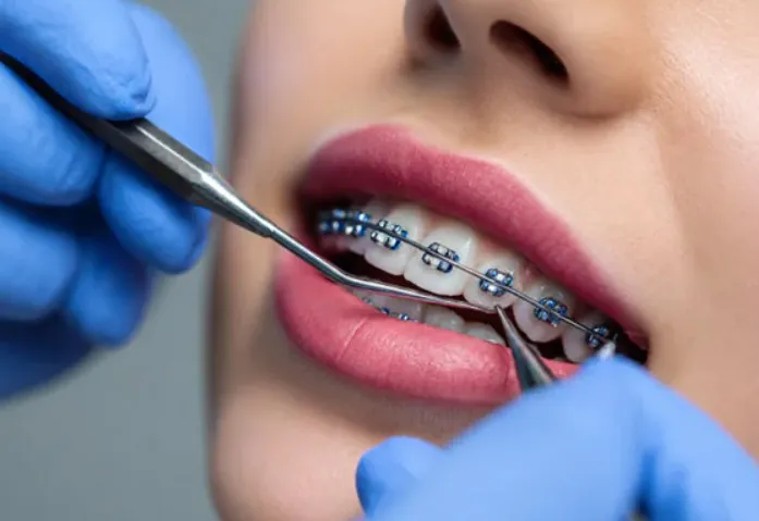 Teeth Whitening in Ajman: Procedure, Benefits, Safety & Results Explained