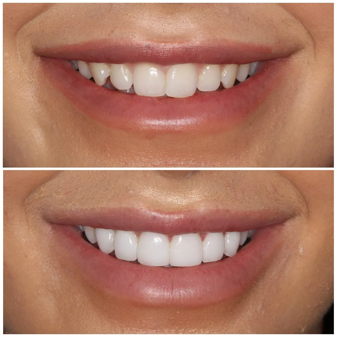 Veneers vs Teeth Whitening: Which Cosmetic Option Suits You Best?