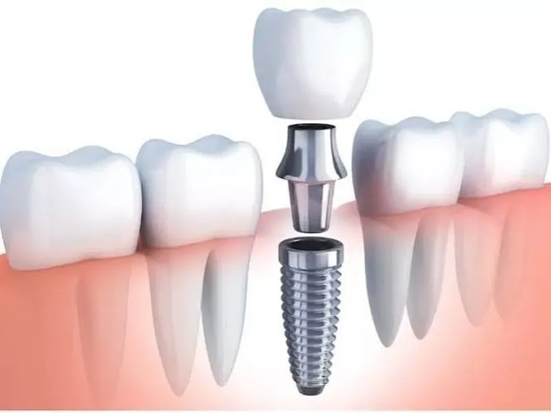 Dental Implants: A Complete Guide to Replacing Missing Teeth