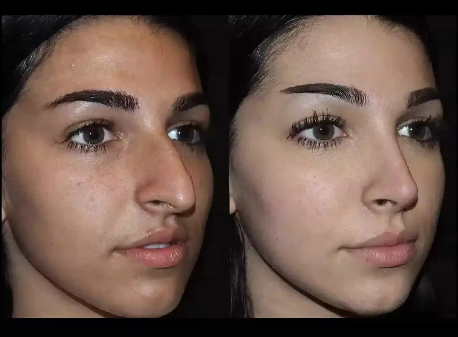How Can Septoplasty in Dubai Support Long-Term Nasal Health?
