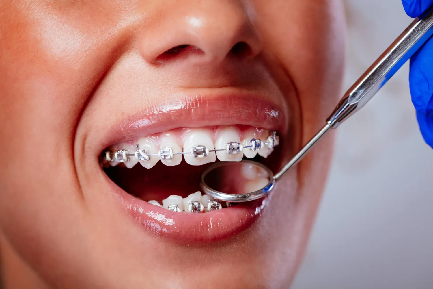 Enjoy Reliable Results Using traditional metal braces for Every Smile