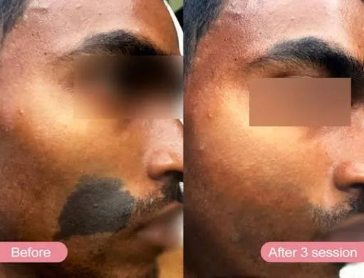 Birthmark removal: types, treatment options & what to expect