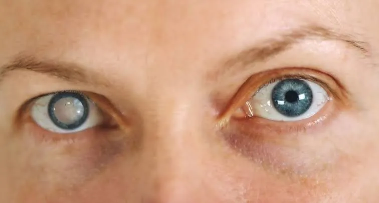 How Long Does Vision Take to Improve After Cataract Surgery?