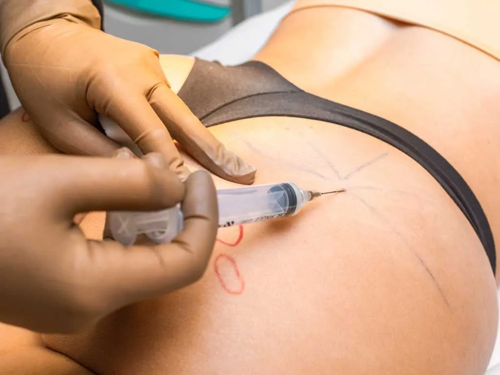 Top Advantages of Professional Butt Fillers Treatment