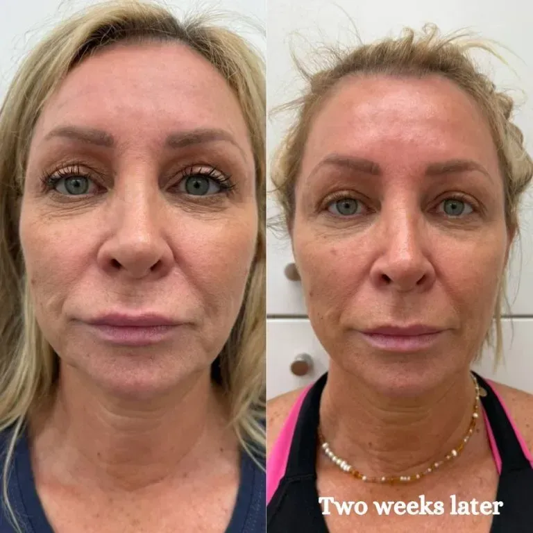 Why HIFU results take time: understanding the collagen remodelling process