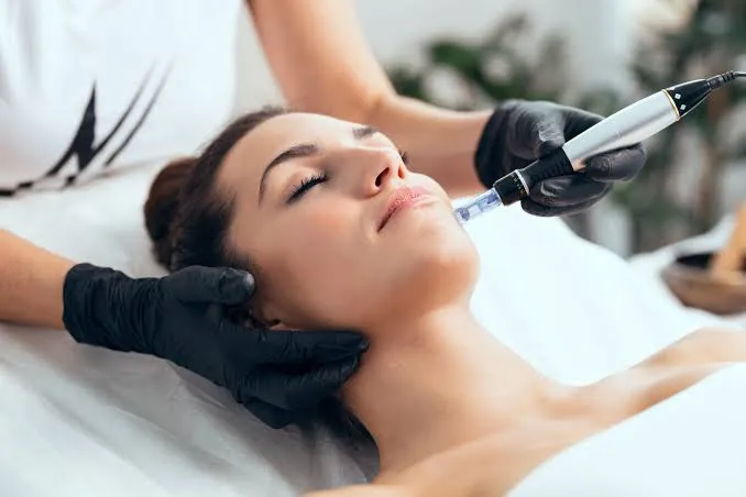 Microneedling Surrey BC: Benefits, Treatment & What to Expect