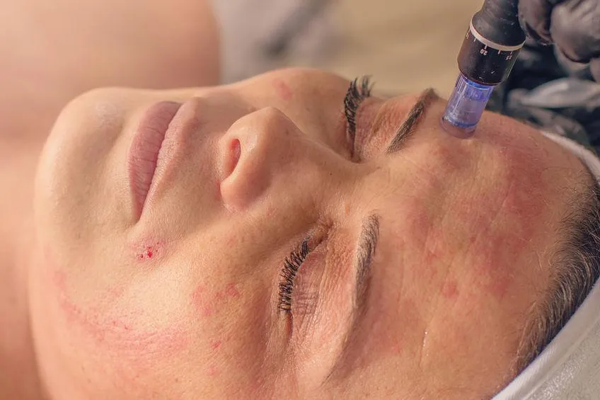 Microneedling Surrey BC: Benefits, Treatment & What to Expect