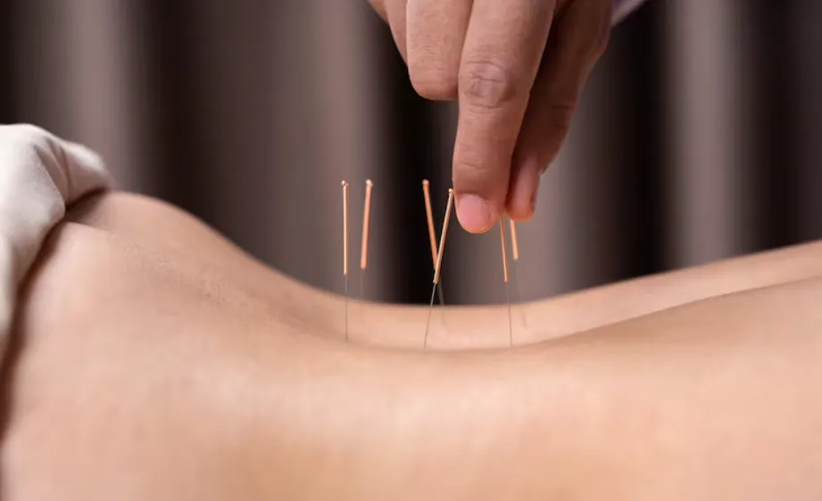 Can San Francisco Acupuncture Help With IVF?