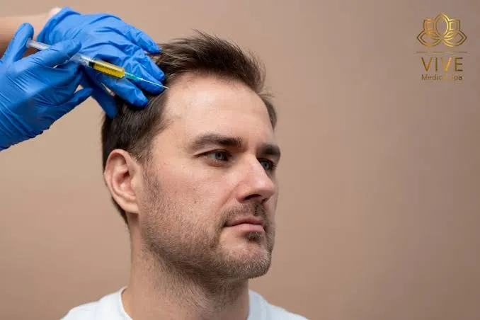 Can PRP Help a Receding Hairline? What It Can and Cannot Do