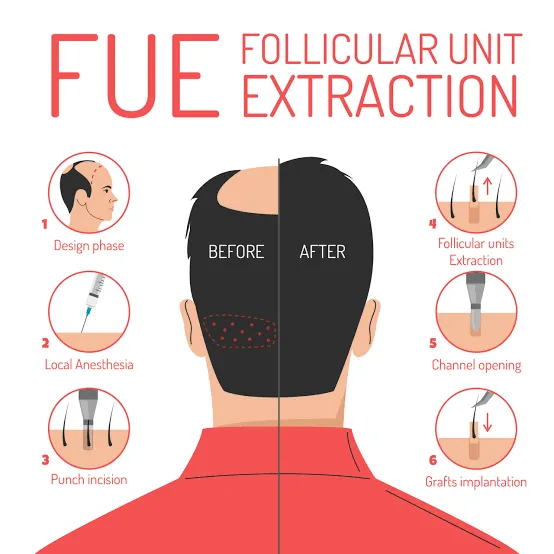 FUE Hair Transplant: Complete Guide for Beginners