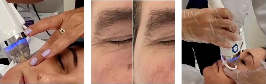 RF Skin Tightening: What You Should Expect Before, During, and After Treatment