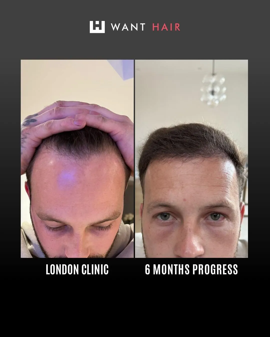 Explore Proven Hair Restoration Options - Best Hair Transplant in the UK