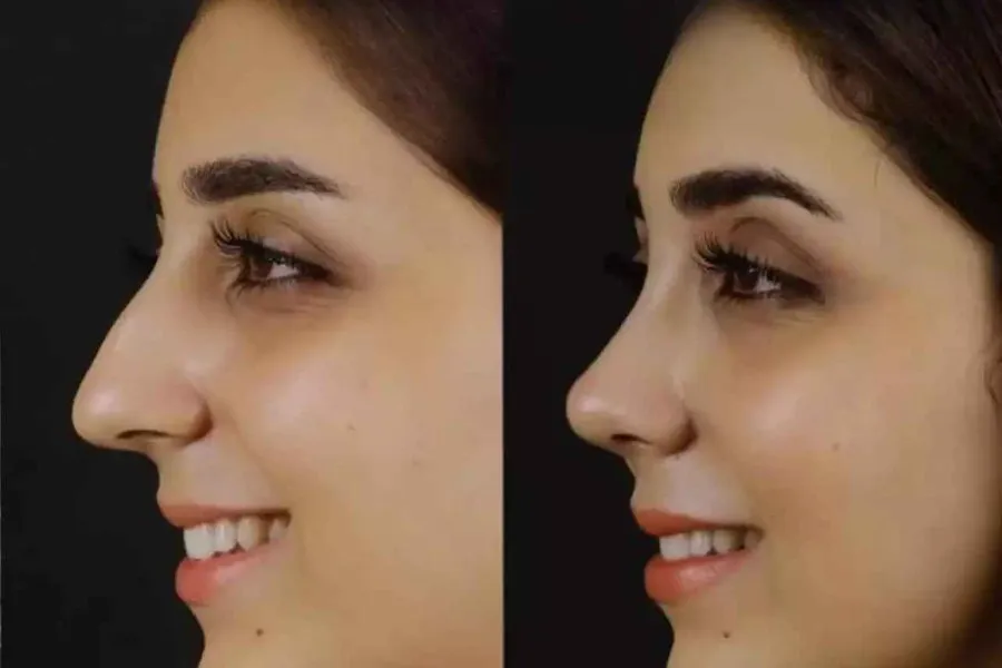 How Can Septoplasty in Dubai Address Breathing Problems?