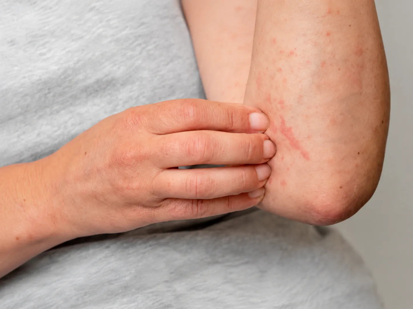 Common Skin Allergies in Rajasthan's Climate: Causes, Triggers, and Treatment Options