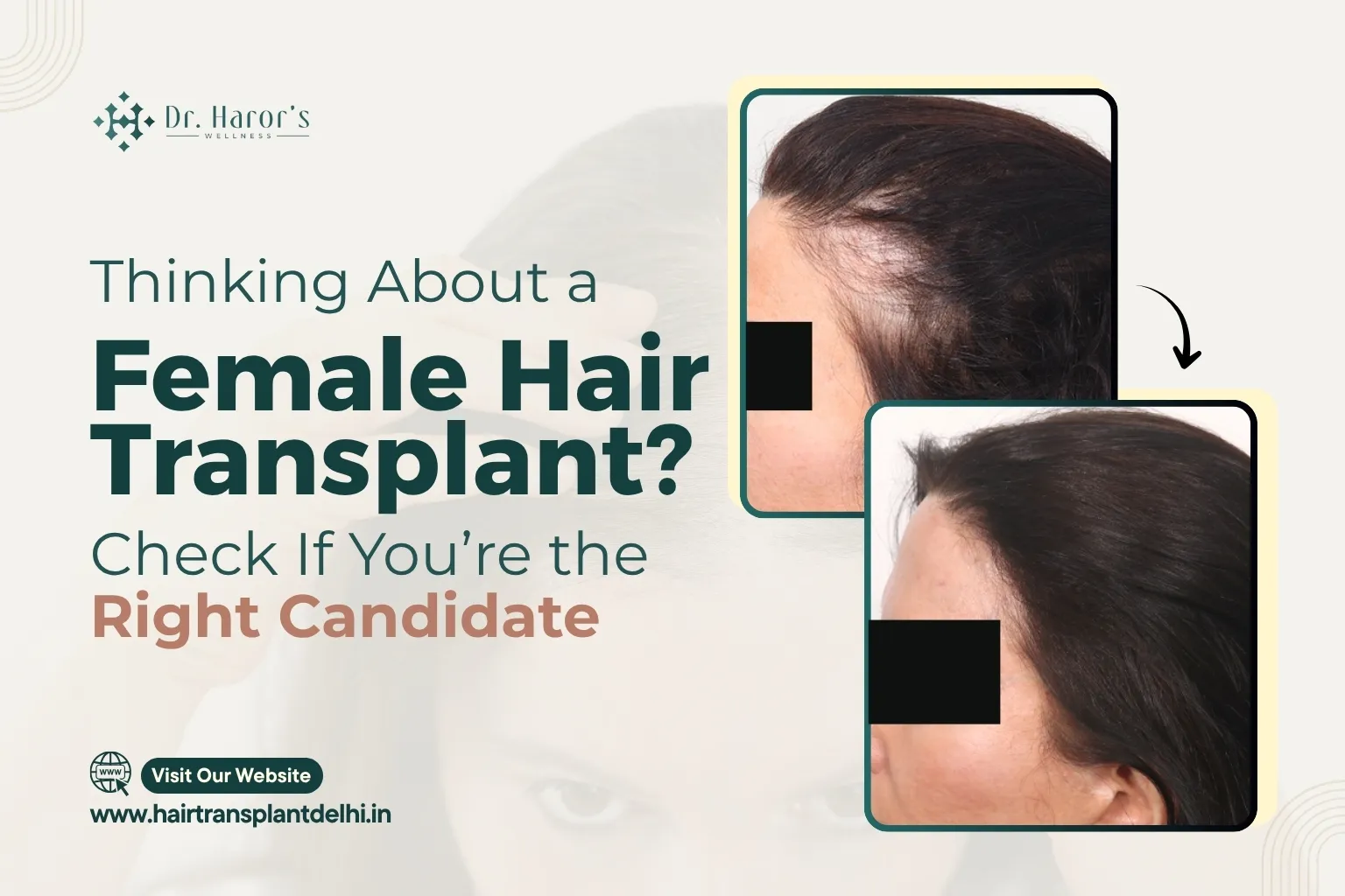 Thinking About a Female Hair Transplant? Check If You’re the Right Candidate