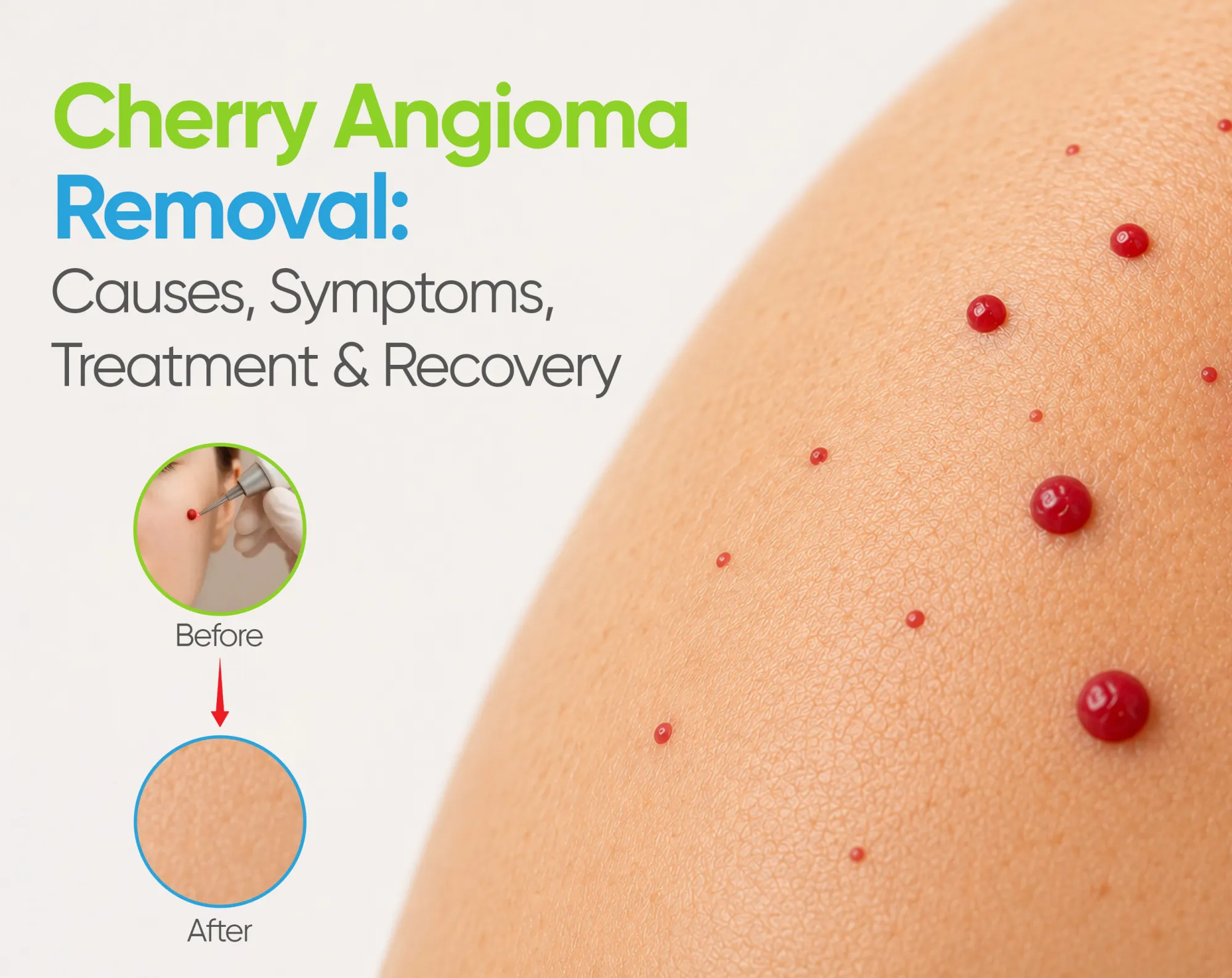 Cherry Angioma Removal Process: Treatments, Recovery, and What to Expect
