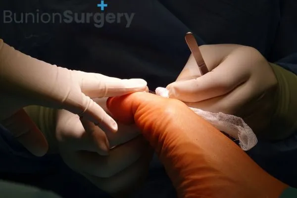 A Smaller Approach to Bunion Correction: What to Know About Minimally Invasive Surgery in Singapore