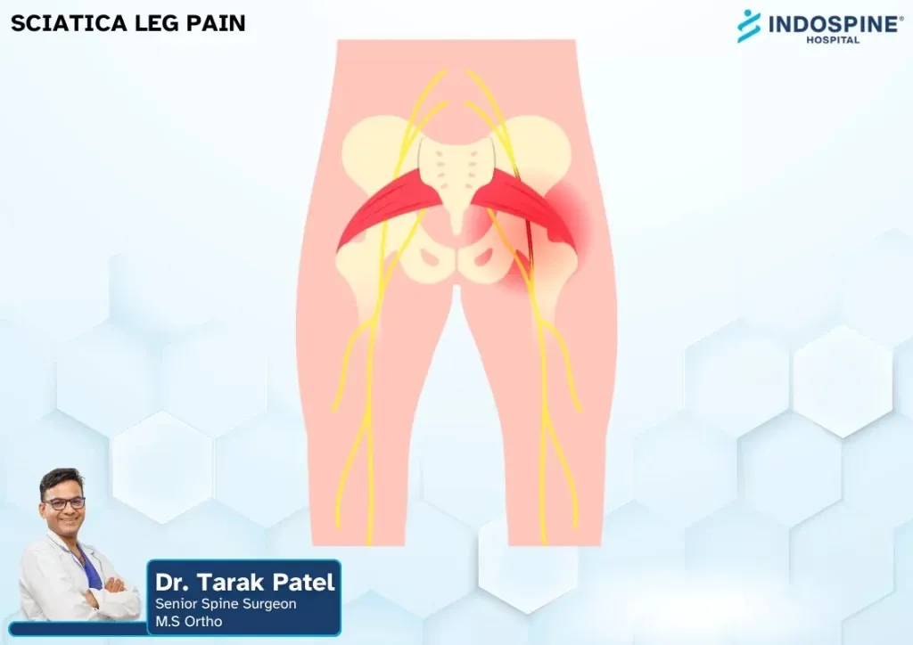 Can You Prevent Sciatica Leg Pain? Expert Tips for a Healthier Spine