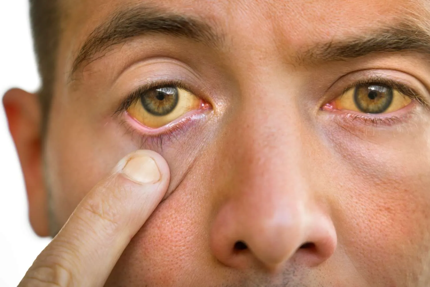 Yellow Eyes and Itchy Skin: Could It Be a Bile Duct Blockage?