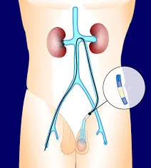 Advanced Varicocele Embolization Montreal for Minimally Invasive Treatment