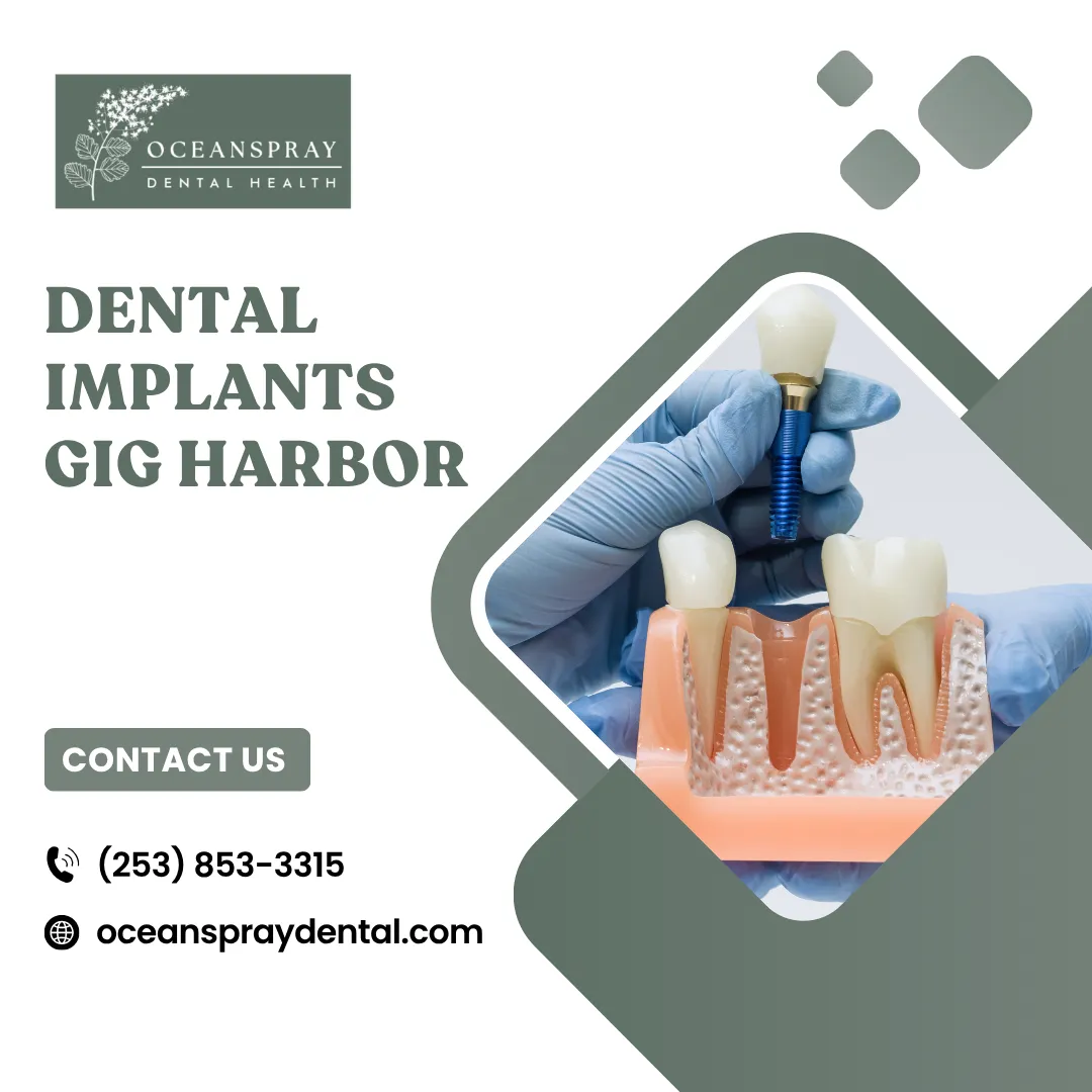 How to Choose the Right Dental Implants Provider in Gig Harbor