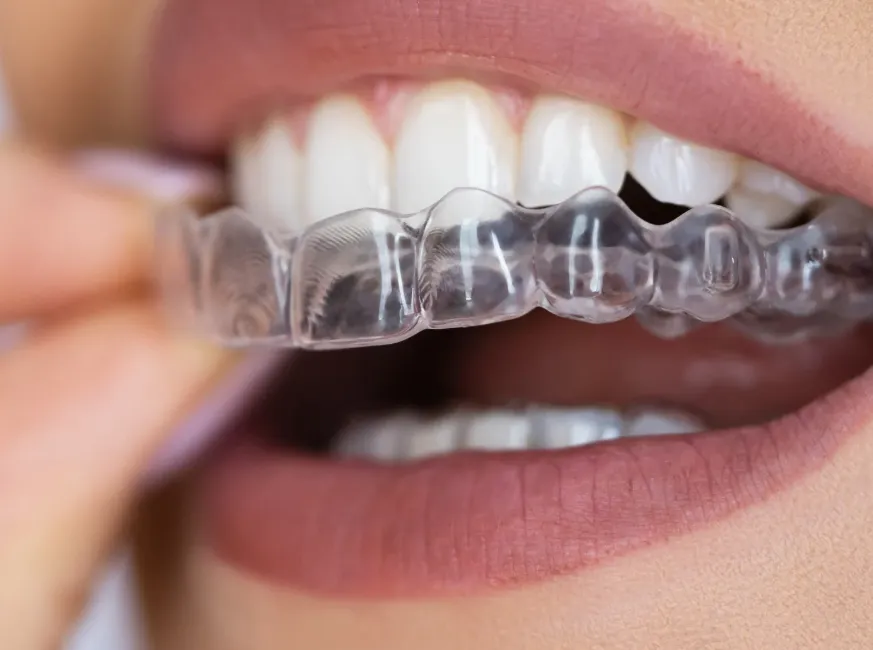 Braces vs Clear Aligners: Which Is Right for You?