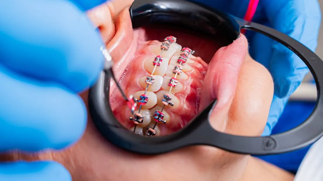 Helping Children Achieve Confident Smiles with Childrens Orthodontics Leamington Spa