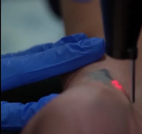 Is Laser Tattoo Removal Safe? What the Research Actually Says