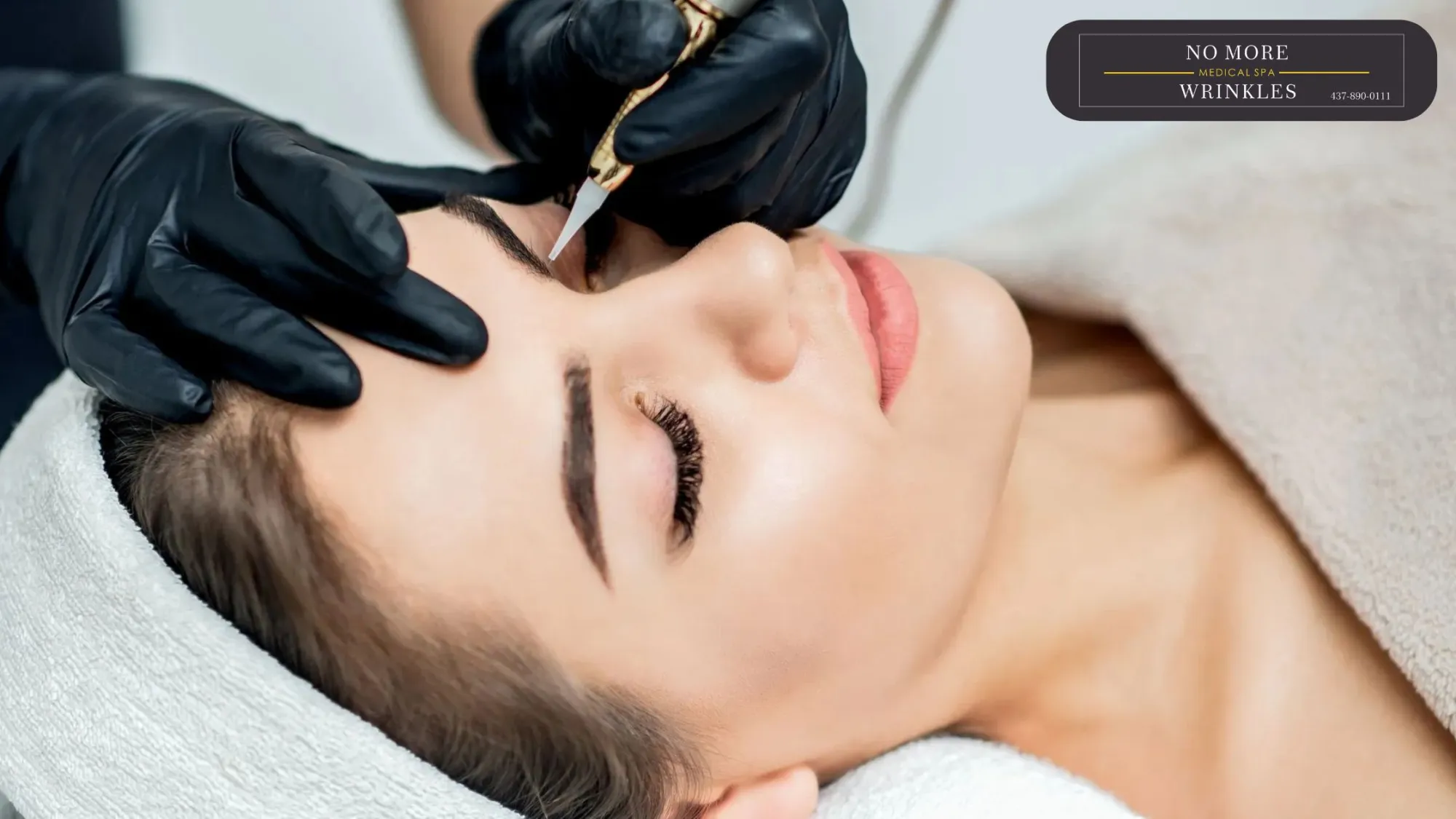 Microneedling in Burlington: 7 Things to Know Before Your First Session