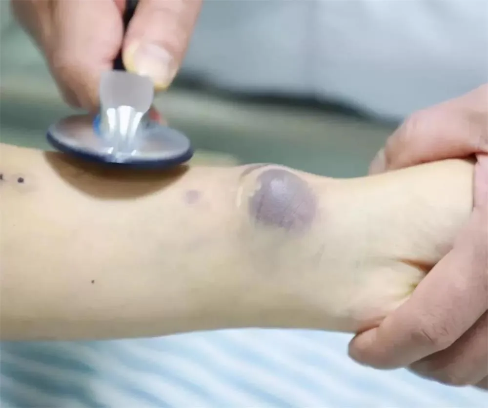 Tracing the Vascular Path: The Pathbreaker's Journey in Vascular Interventional Therapy