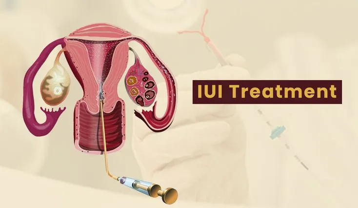 IUI Cost in Delhi: What Patients Should Know Before Treatment