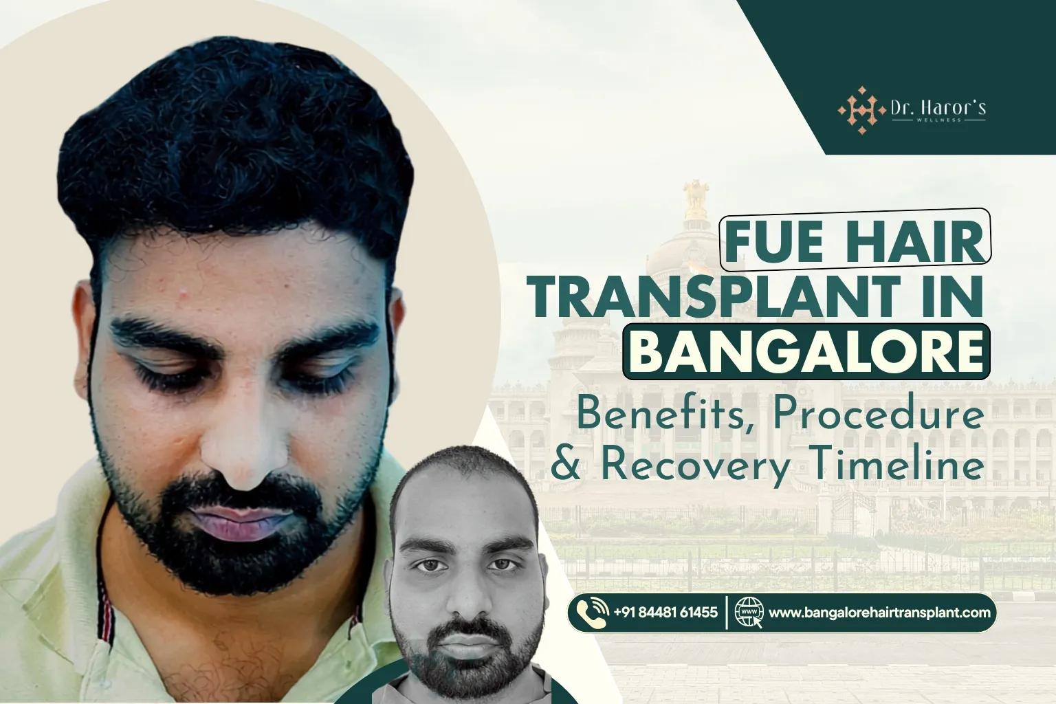 FUE Hair Transplant in Bangalore: What It Costs, How It Works, and What to Expect During Recovery