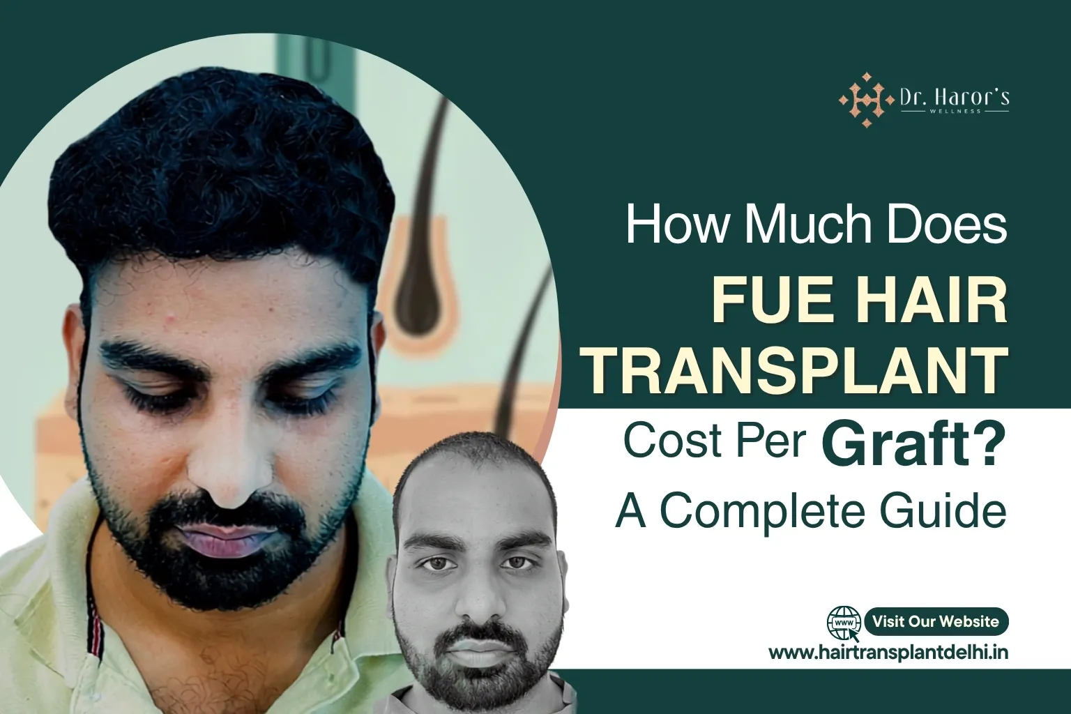 FUE Hair Transplant Cost Per Graft: What You'll Actually Pay in 2026