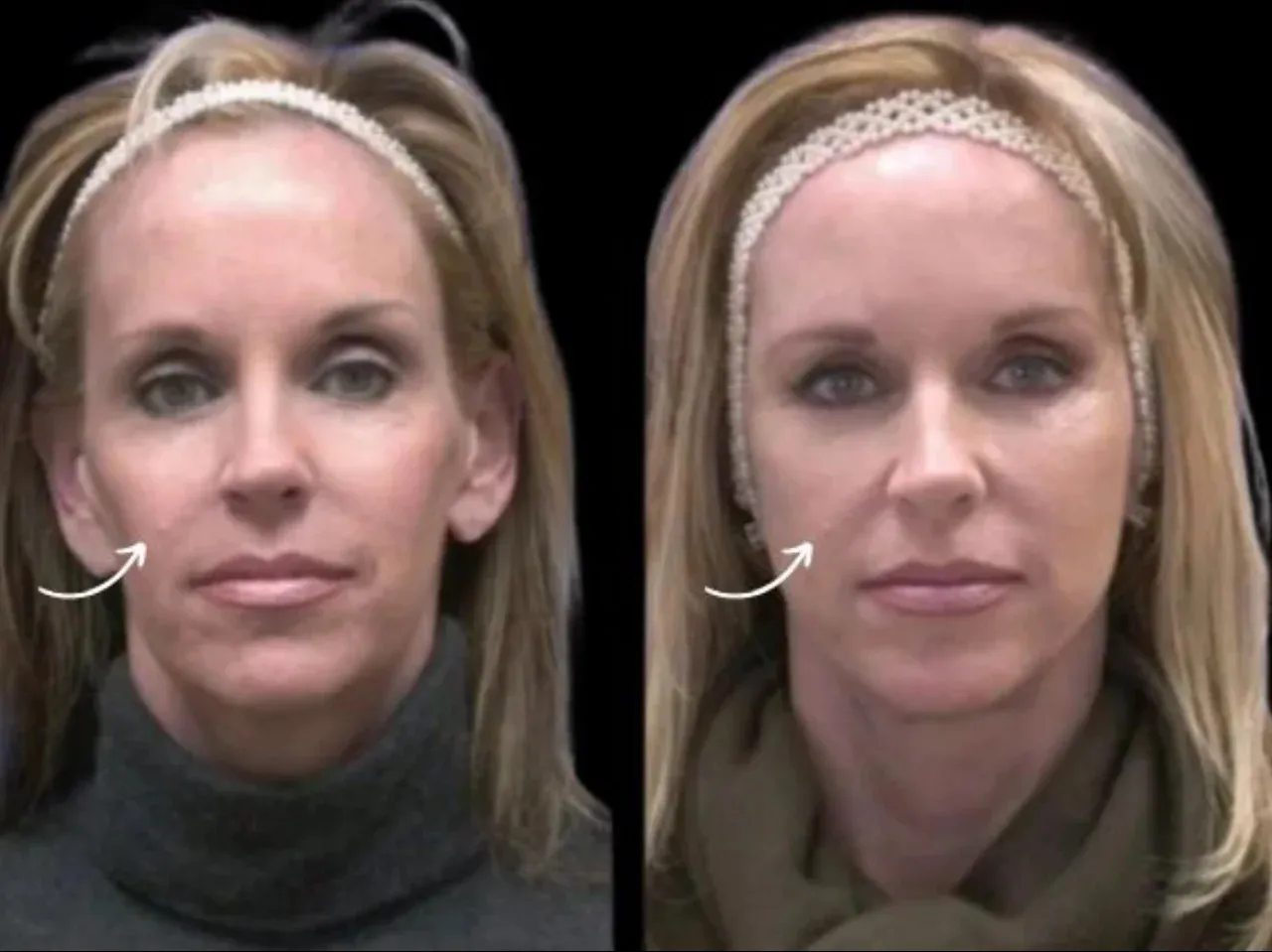 Best Aesthetic Clinic in Dubai for Sculptra Jawline Renewal