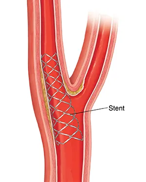 How Specialists Perform Carotid Artery Stenting in Sector 43 Gurugram