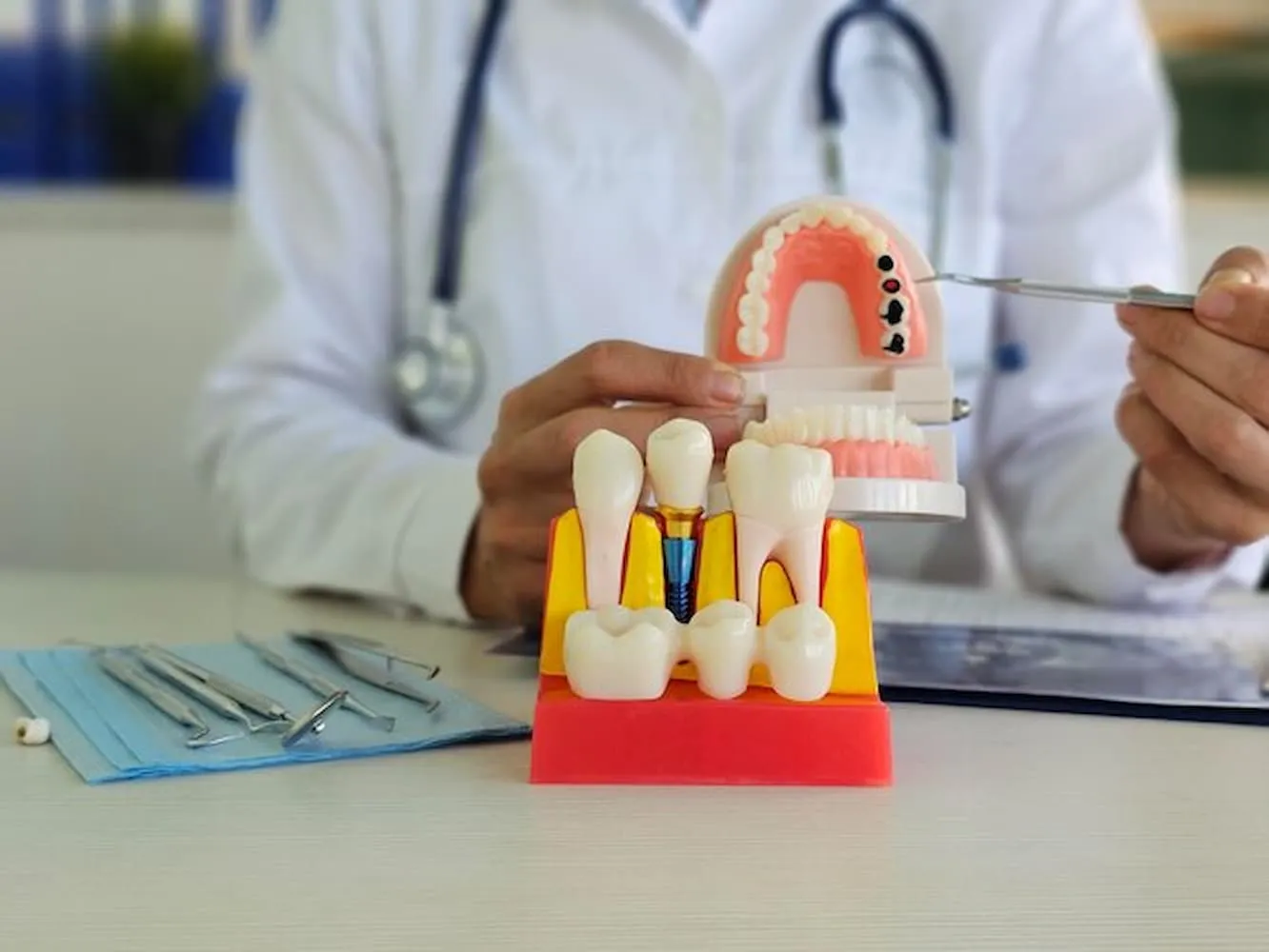 Benefits of Choosing Columbus Dental Implants for Missing Teeth