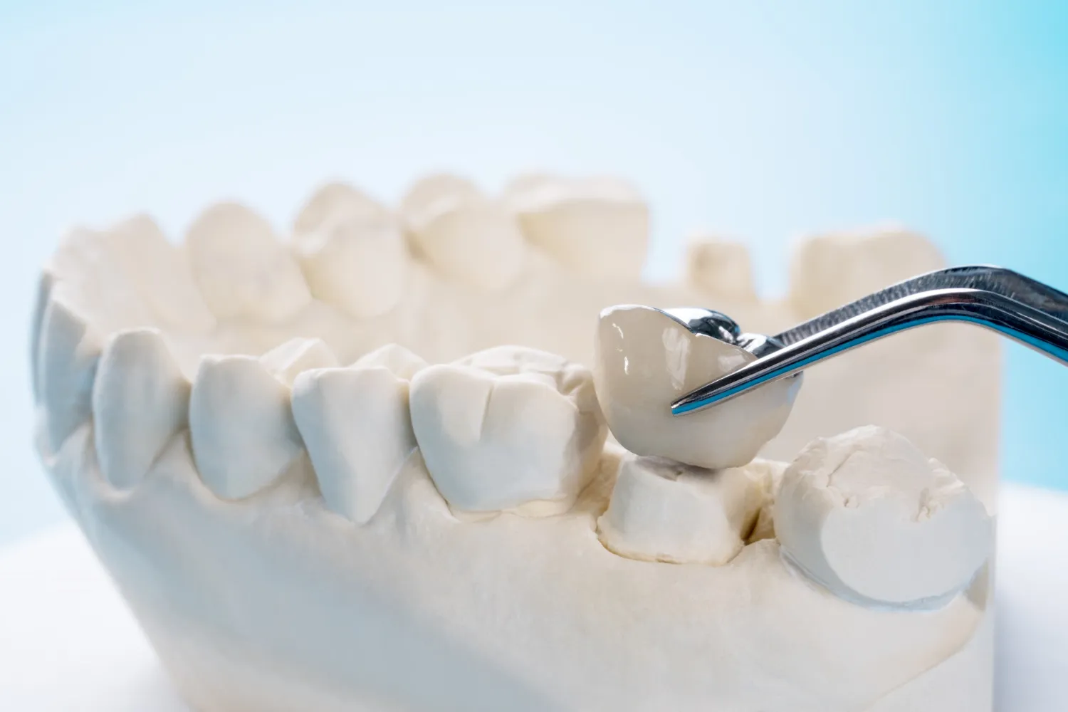 A Guide to Choosing Reliable Denture Repair Santa Ana Services