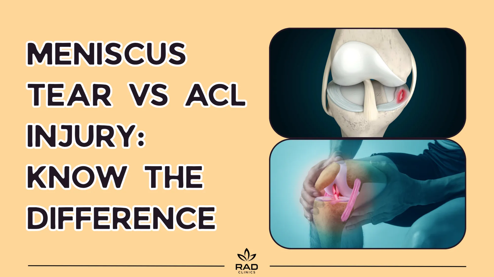 Meniscus Tear vs ACL Injury: Know the Difference