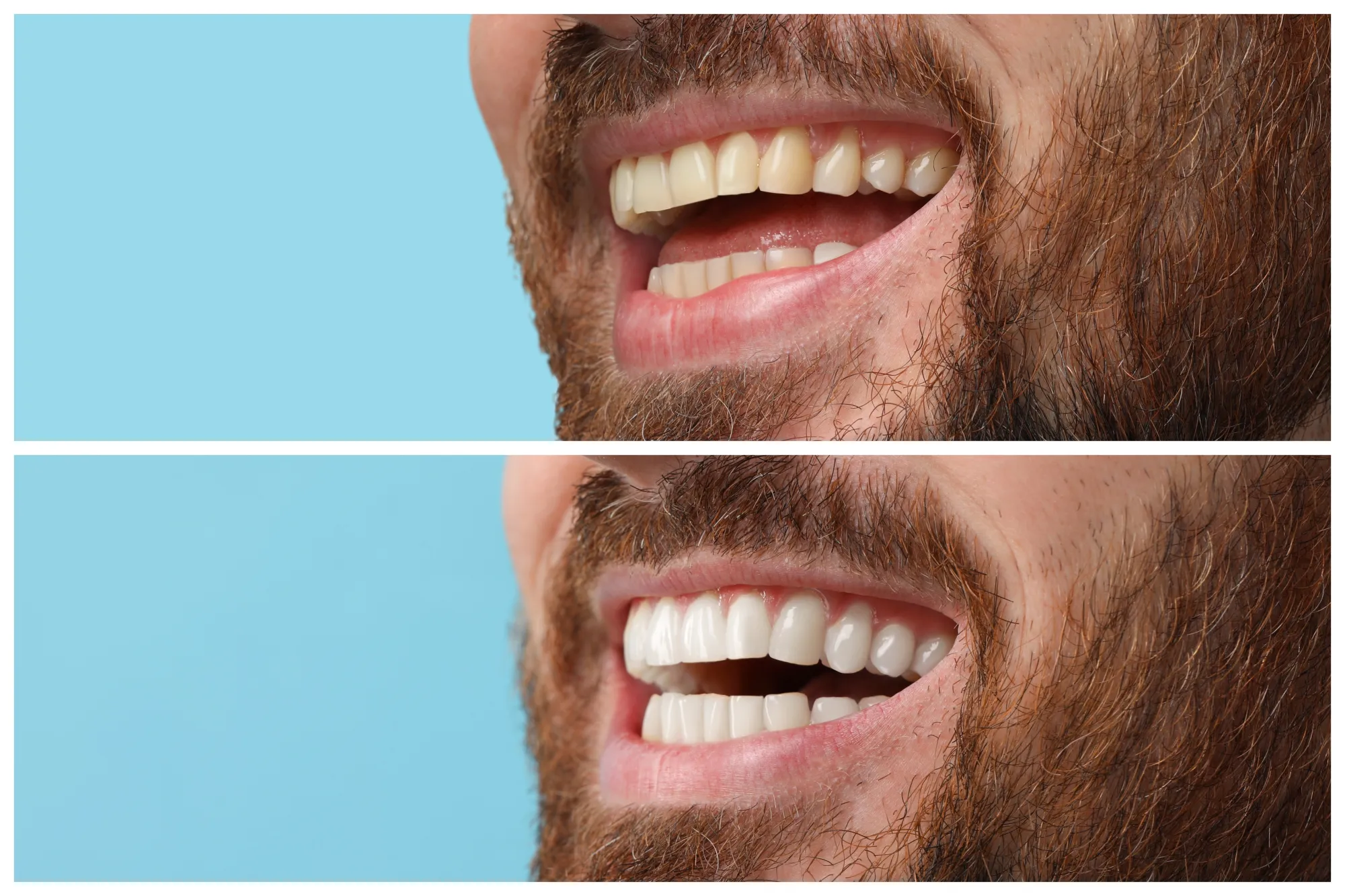 How Teeth Whitening Helps Refresh Your Smile Safely