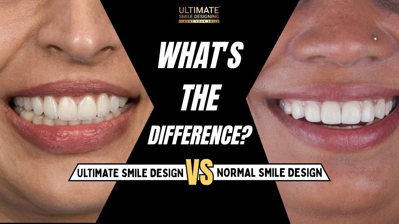Normal Smile Design vs Ultimate Smile Design: What Makes the Difference?