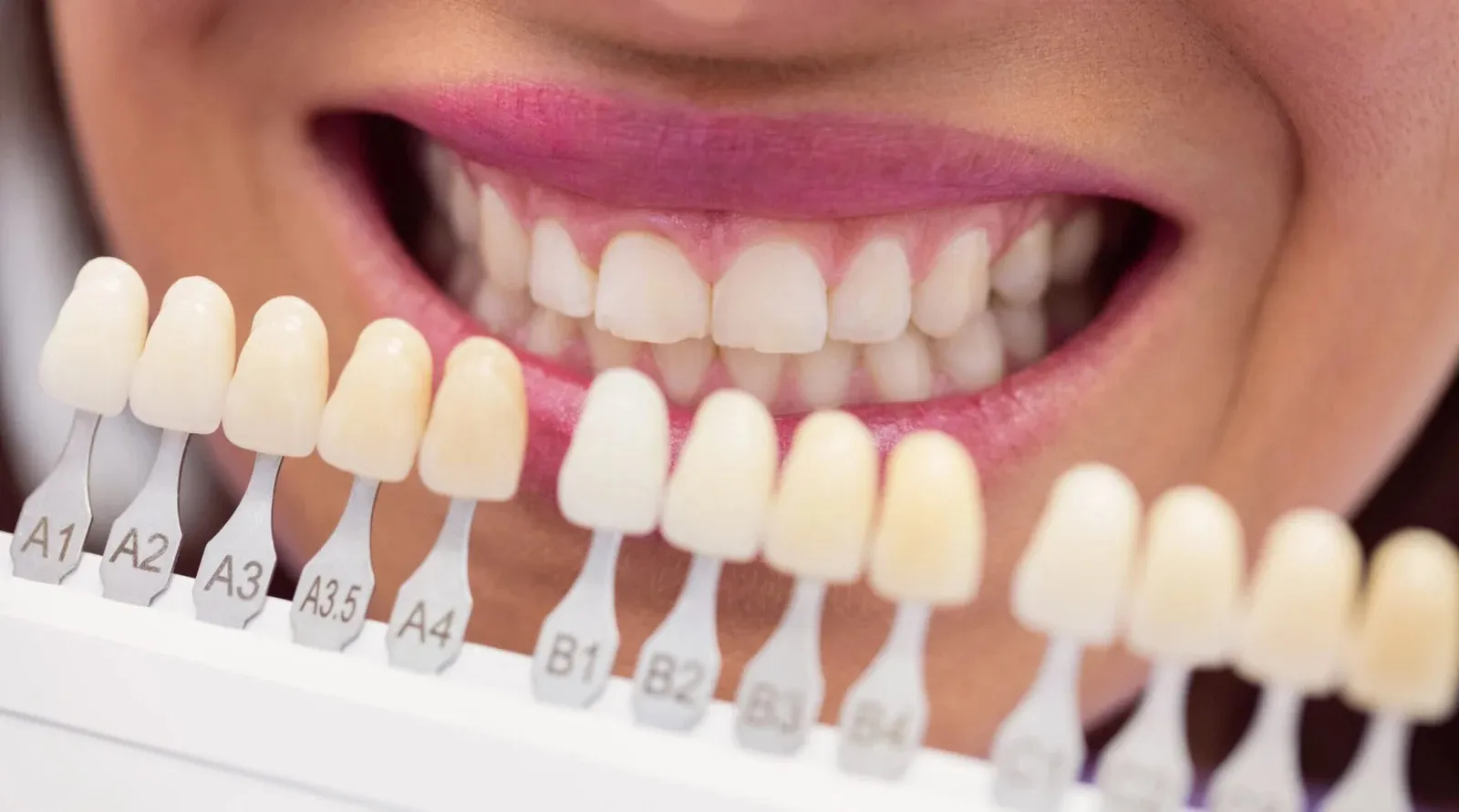Dental Veneers in Kondapur: Transform Your Smile with Advanced Cosmetic Dentistry