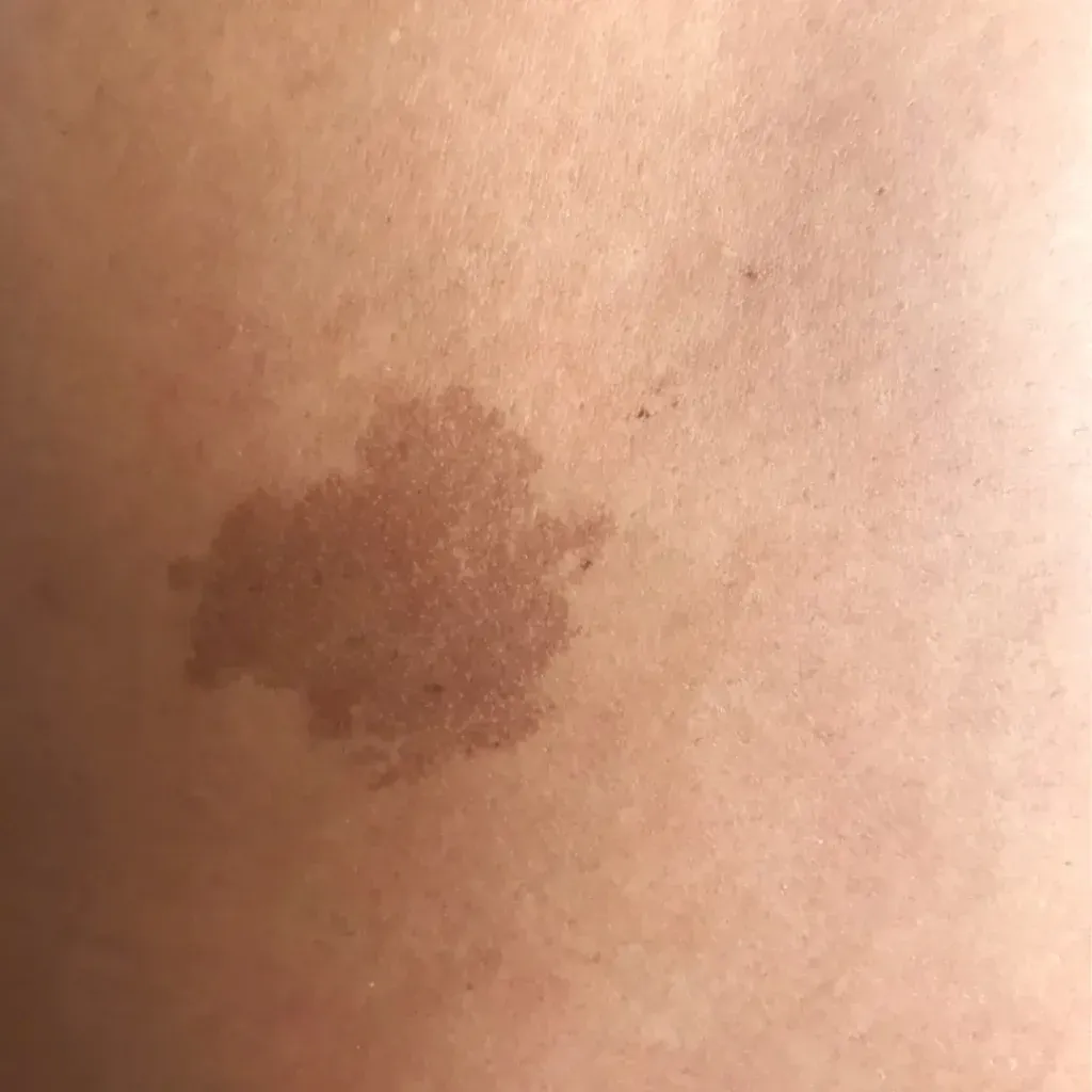 What Affects Birthmark Removal Treatment Results? Key Factors to Know