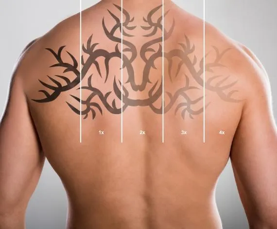 How Effective Is PicoSure Laser Tattoo Removal Today?