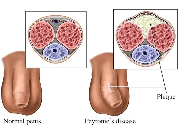 Peyronie’s Disease Treatment in Pakistan