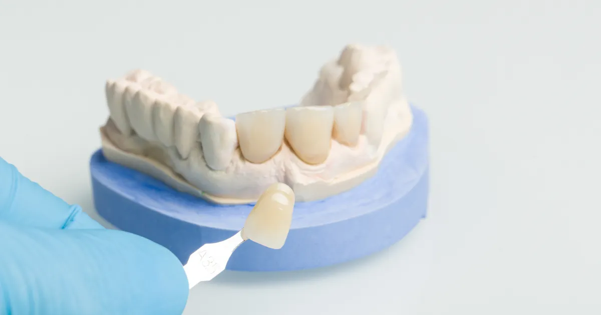 Veneer Teeth Price in Lahore: A Complete Guide to Costs, Options, and Value